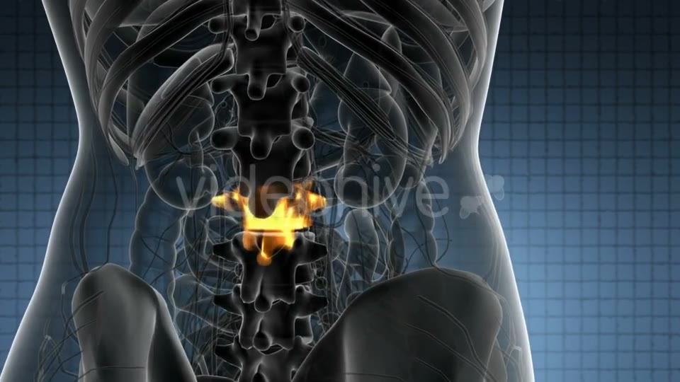 Backache in Back Bones - Download Videohive 20823629
