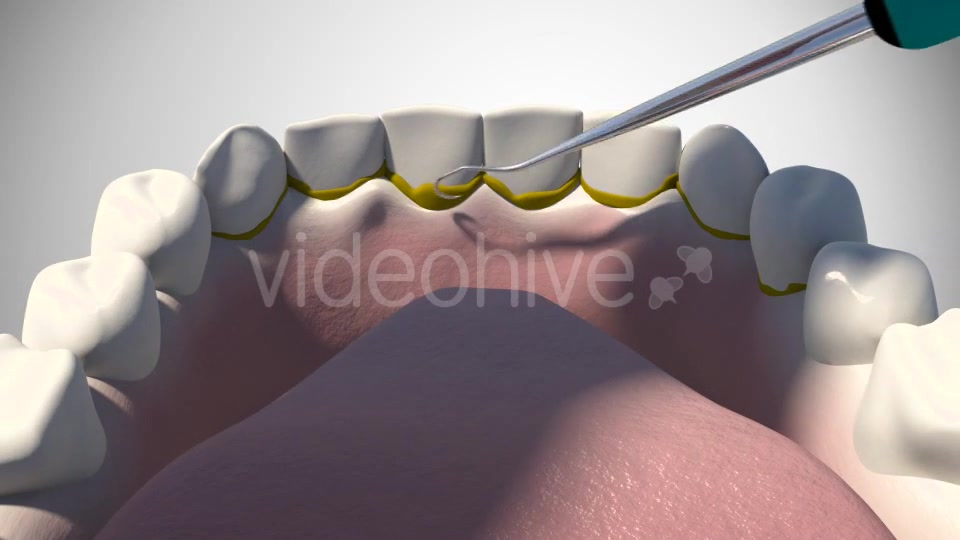 3D Dental Scaling Videohive 18397847 Motion Graphics Image 4
