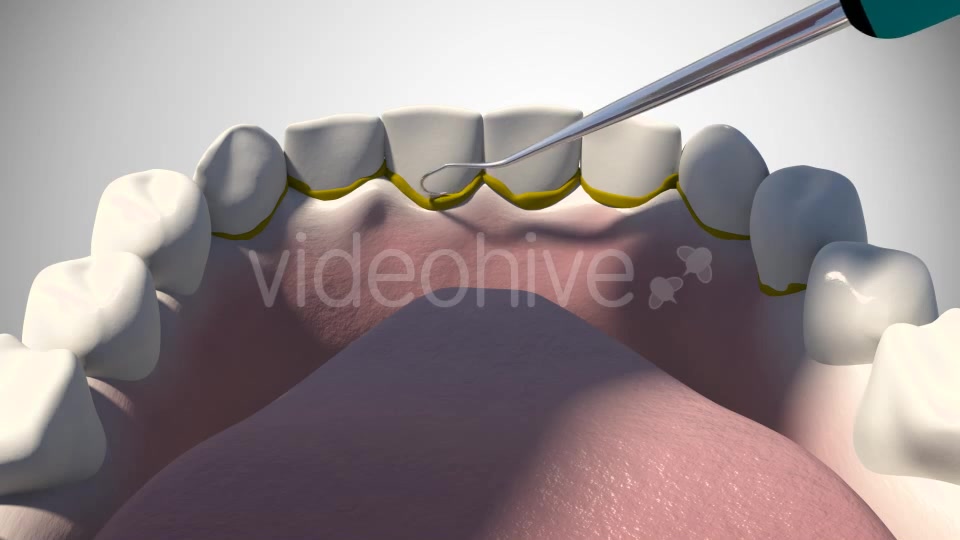 3D Dental Scaling Videohive 18397847 Motion Graphics Image 5