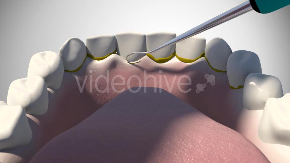 3D Dental Scaling Videohive 18397847 Motion Graphics Image 6