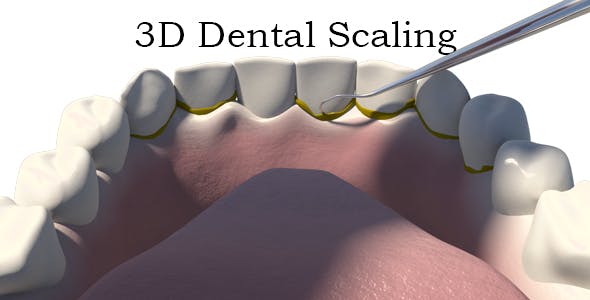 3D Dental Scaling - 18397847 Videohive Download