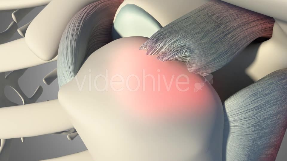 3D Rotator Cuff Tear Videohive 20511731 Motion Graphics Image 10