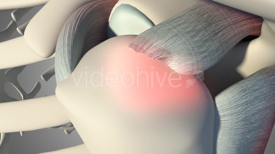 3D Rotator Cuff Tear Videohive 20511731 Motion Graphics Image 9