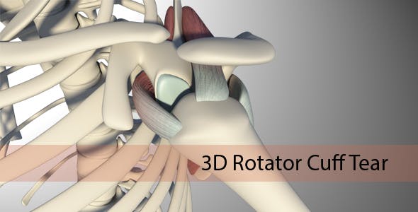 3D Rotator Cuff Tear Quick Download Videohive 20511731 Motion Graphics