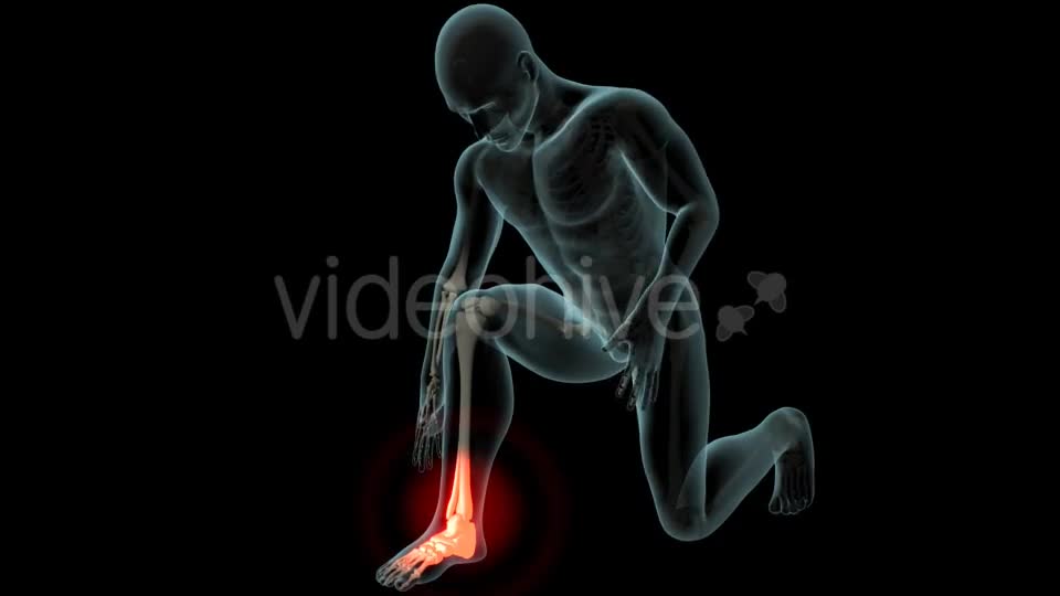 Ankle Pain Videohive 21290882 Motion Graphics Image 1