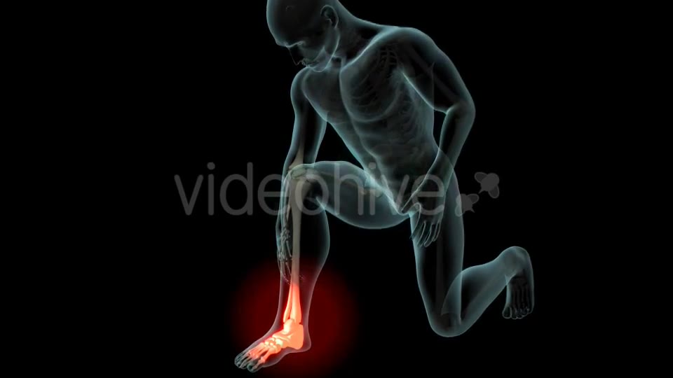 Ankle Pain Videohive 21290882 Motion Graphics Image 2