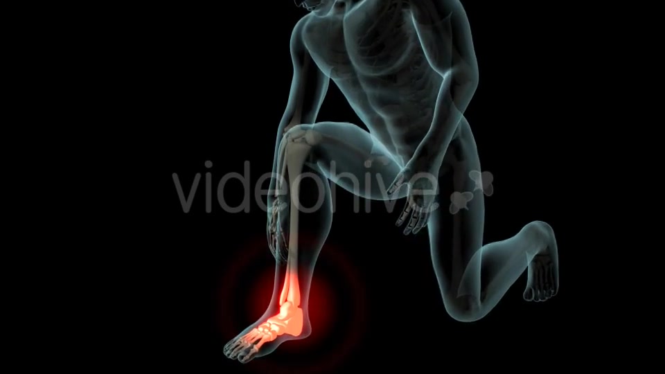Ankle Pain Videohive 21290882 Motion Graphics Image 3