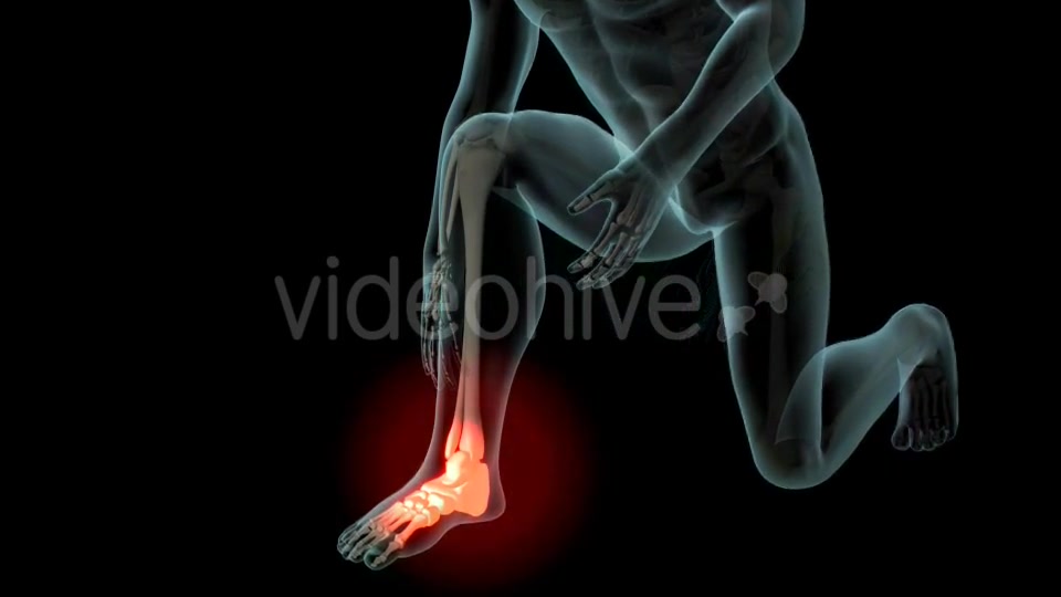 Ankle Pain Videohive 21290882 Motion Graphics Image 4