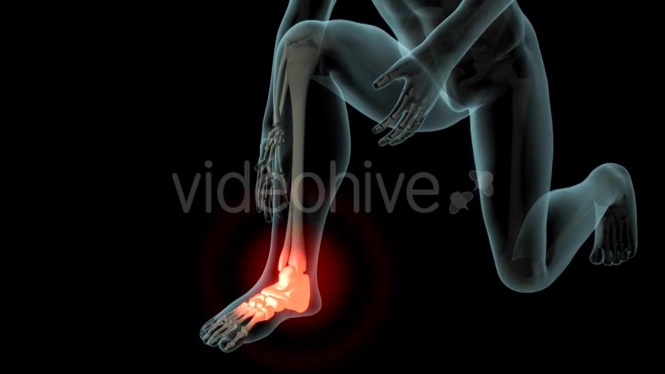 Ankle Pain Videohive 21290882 Motion Graphics Image 5