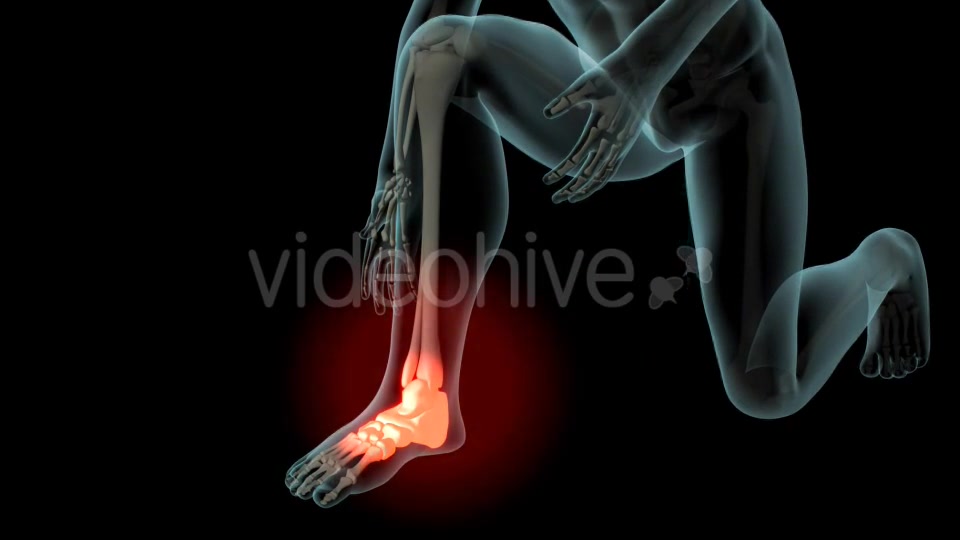 Ankle Pain Videohive 21290882 Motion Graphics Image 6