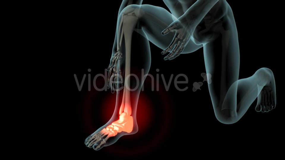 Ankle Pain Videohive 21290882 Motion Graphics Image 7