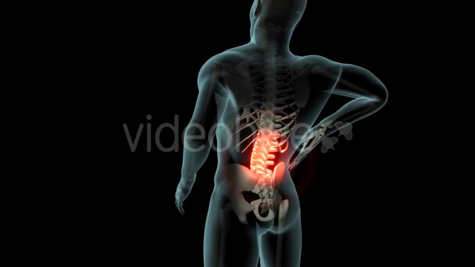 Back Pain Videohive 21254728 Motion Graphics Image 3