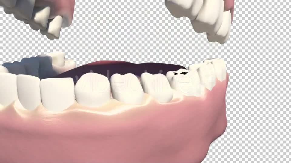 Caries Removal And Cavity Filling Videohive 19282454 Motion Graphics Image 1