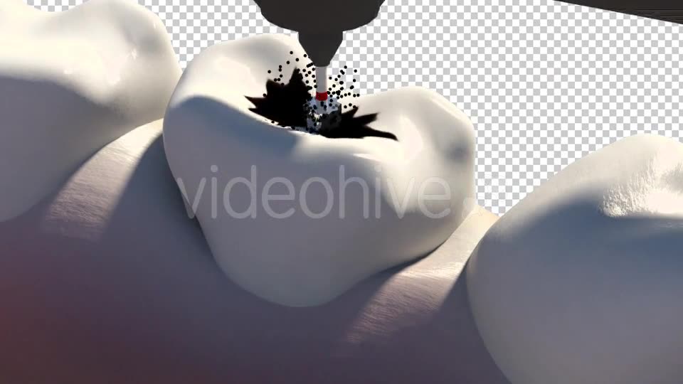 Caries Removal And Cavity Filling Videohive 19282454 Motion Graphics Image 2