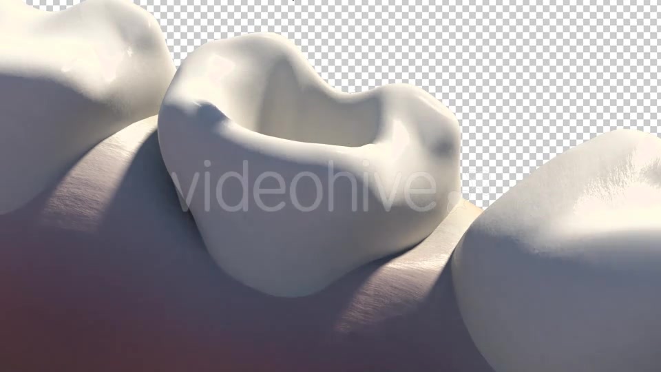 Caries Removal And Cavity Filling Videohive 19282454 Motion Graphics Image 3