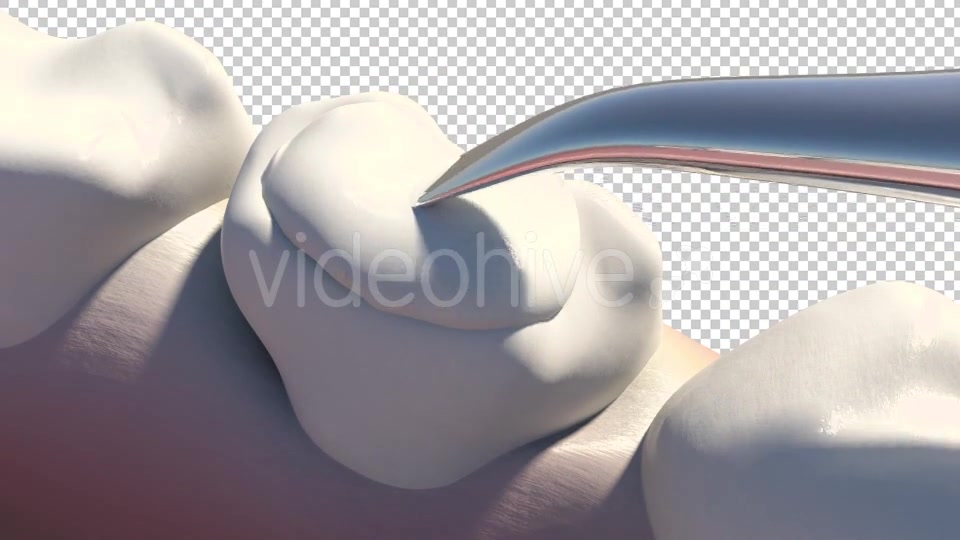 Caries Removal And Cavity Filling Videohive 19282454 Motion Graphics Image 4