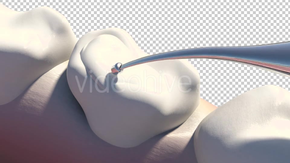 Caries Removal And Cavity Filling Videohive 19282454 Motion Graphics Image 5