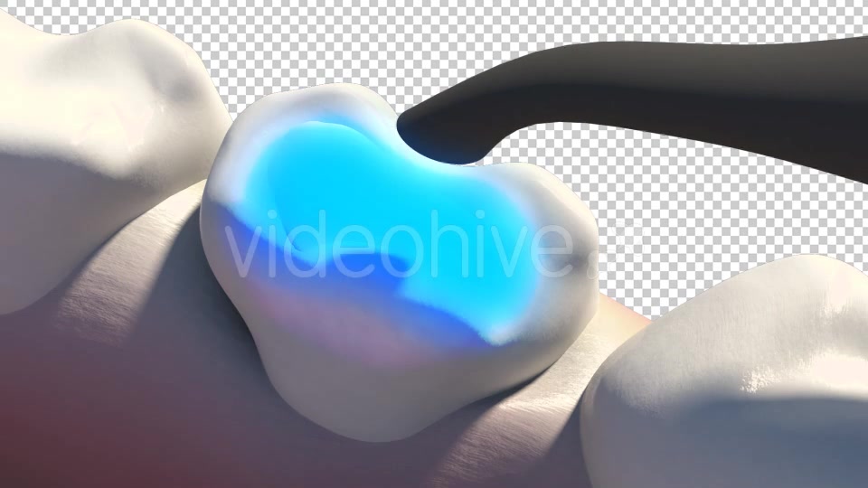 Caries Removal And Cavity Filling Videohive 19282454 Motion Graphics Image 6