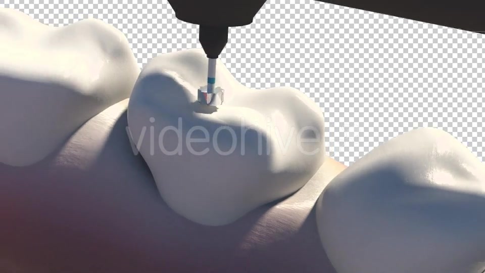 Caries Removal And Cavity Filling Videohive 19282454 Motion Graphics Image 8