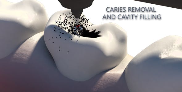 Caries Removal And Cavity Filling - Download Videohive 19282454