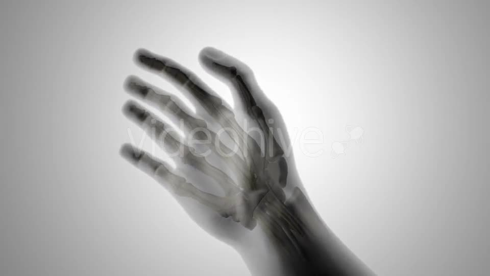 Carpal Tunnel Syndrome Videohive 20207663 Motion Graphics Image 1