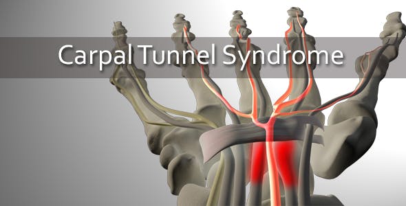 Carpal Tunnel Syndrome - 20207663 Videohive Download
