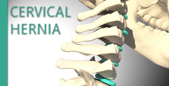 Cervical Hernia - Download 14830431 Videohive