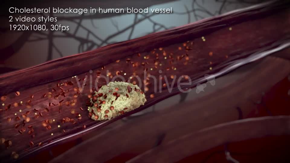 Cholesterol Buildup Clogging Artery Videohive 12776853 Motion Graphics Image 1
