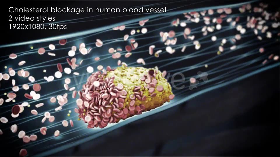 Cholesterol Buildup Clogging Artery Videohive 12776853 Motion Graphics Image 10