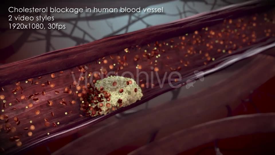 Cholesterol Buildup Clogging Artery Videohive 12776853 Motion Graphics Image 2