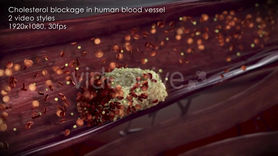 Cholesterol Buildup Clogging Artery Videohive 12776853 Motion Graphics Image 4