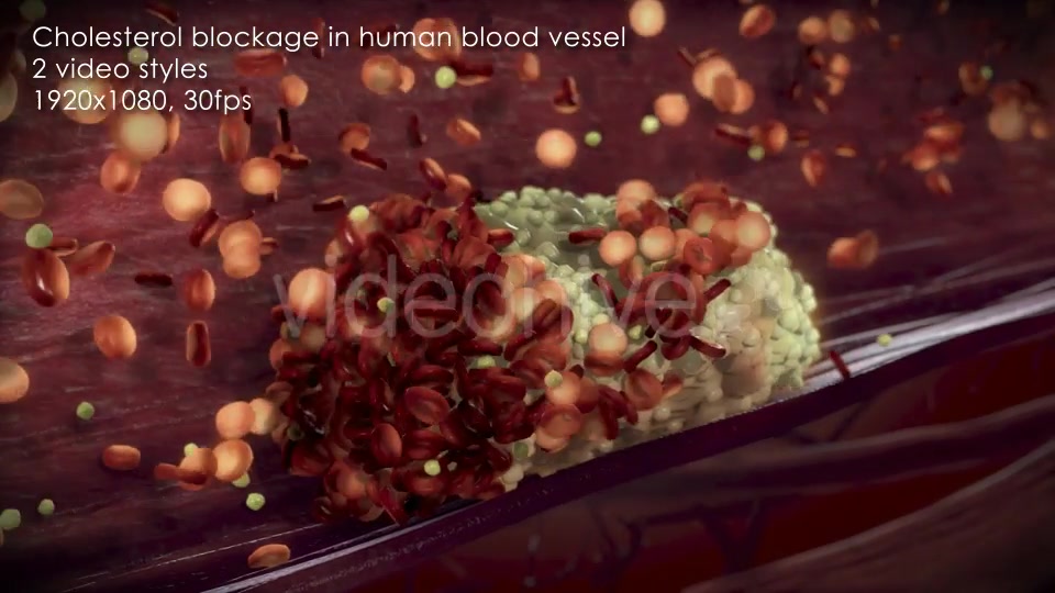 Cholesterol Buildup Clogging Artery Videohive 12776853 Motion Graphics Image 6