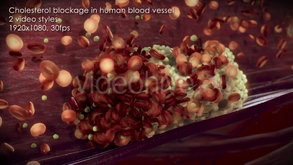 Cholesterol Buildup Clogging Artery Videohive 12776853 Motion Graphics Image 7
