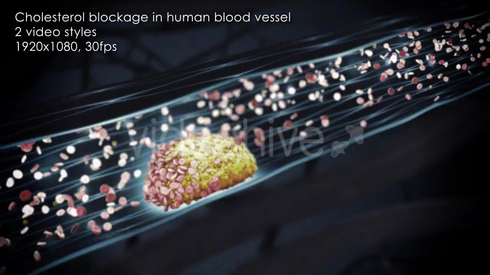 Cholesterol Buildup Clogging Artery Videohive 12776853 Motion Graphics Image 8