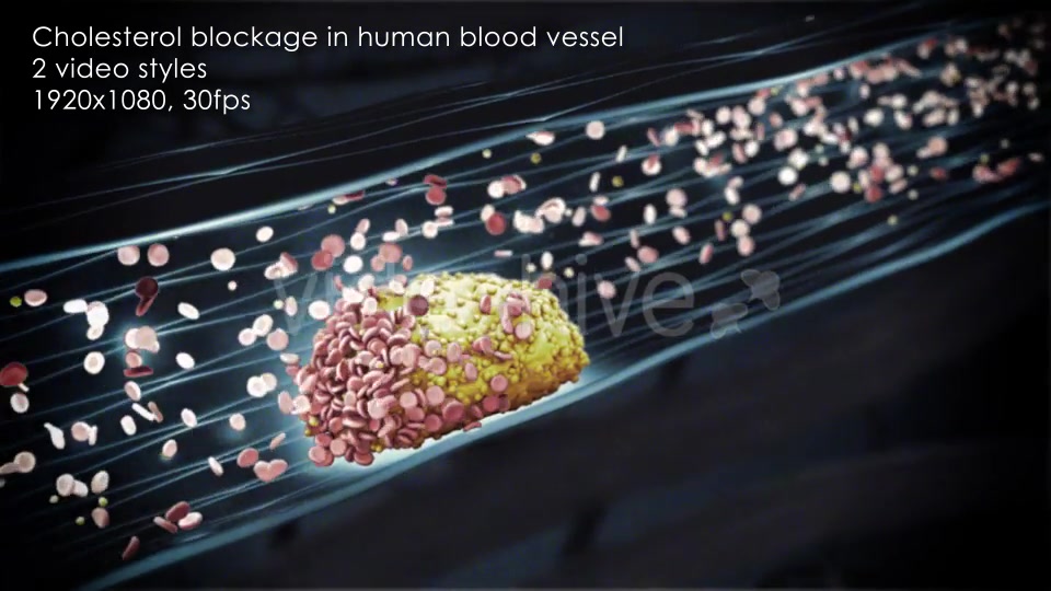 Cholesterol Buildup Clogging Artery Videohive 12776853 Motion Graphics Image 9