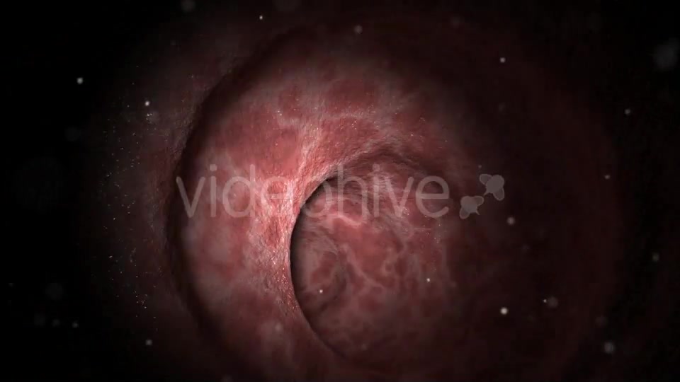 Colon Polypectomy Videohive 19660610 Motion Graphics Image 5