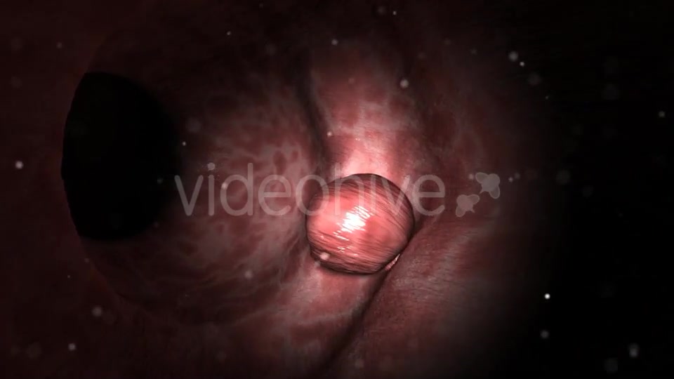 Colon Polypectomy Videohive 19660610 Motion Graphics Image 6