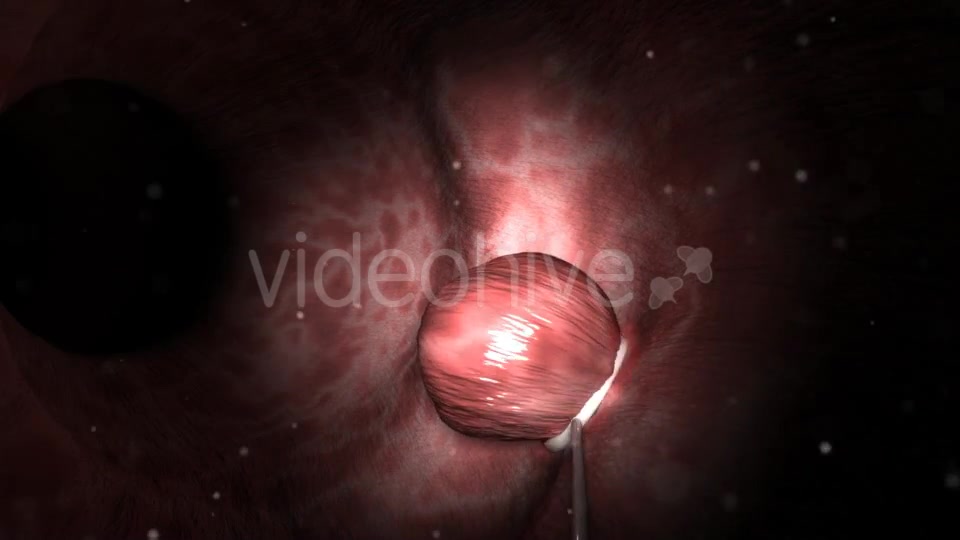 Colon Polypectomy Videohive 19660610 Motion Graphics Image 7