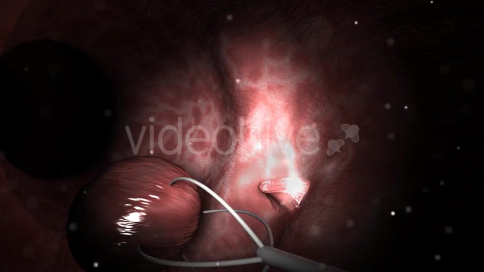 Colon Polypectomy Videohive 19660610 Motion Graphics Image 8