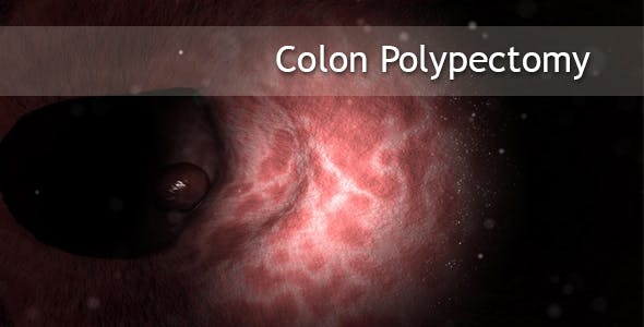 Colon Polypectomy - Videohive Download 19660610