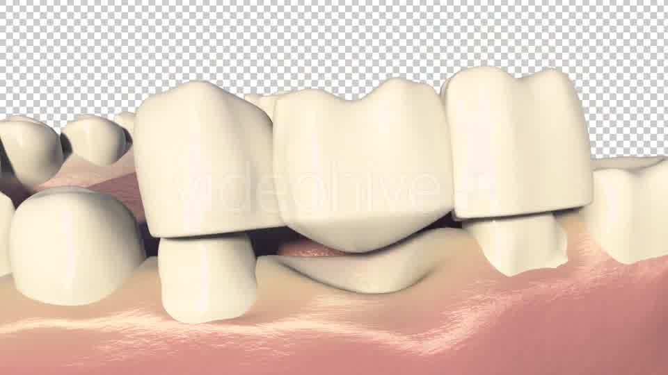 Dental Bridges (3 Unit Bridges Procedure) Videohive 19270540 Motion Graphics Image 10