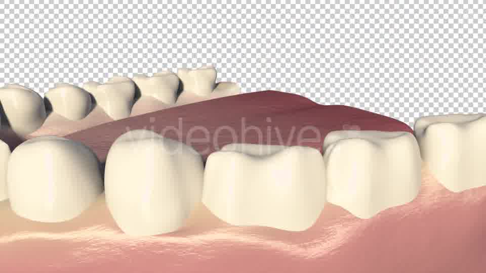 Dental Bridges (3 Unit Bridges Procedure) Videohive 19270540 Motion Graphics Image 11