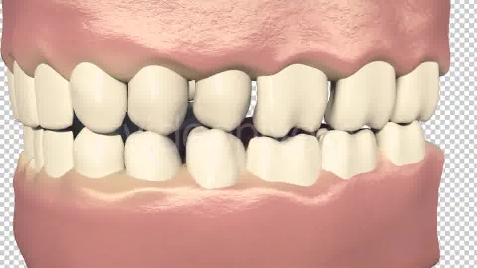 Dental Bridges (3 Unit Bridges Procedure) Videohive 19270540 Motion Graphics Image 12