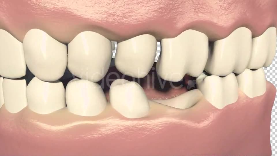 Dental Bridges (3 Unit Bridges Procedure) Videohive 19270540 Motion Graphics Image 2