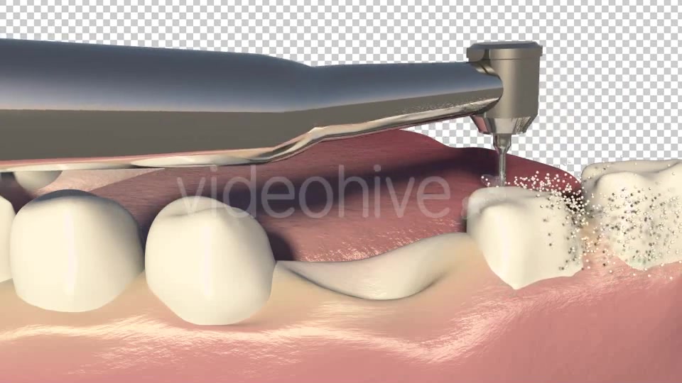 Dental Bridges (3 Unit Bridges Procedure) Videohive 19270540 Motion Graphics Image 5