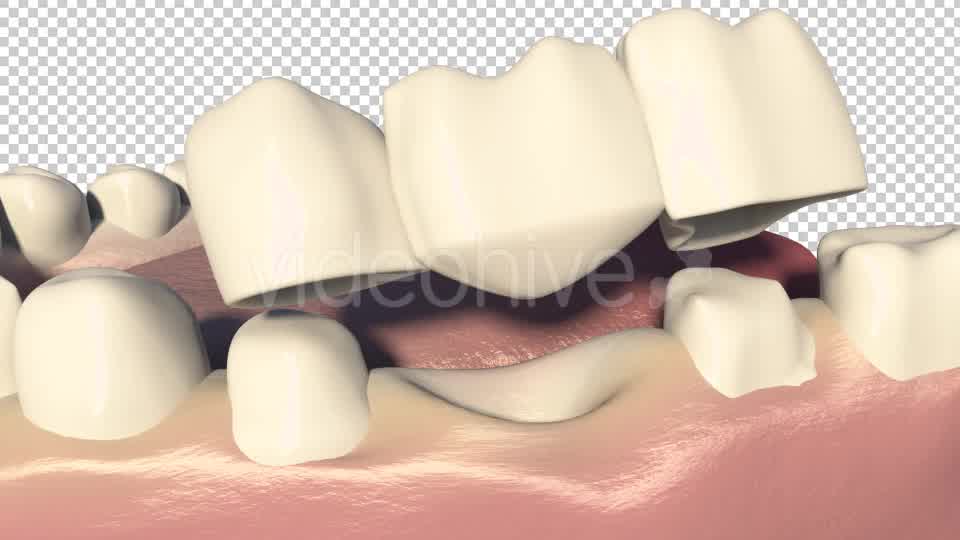 Dental Bridges (3 Unit Bridges Procedure) Videohive 19270540 Motion Graphics Image 9