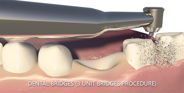Dental Bridges (3 Unit Bridges Procedure) - Download Videohive 19270540