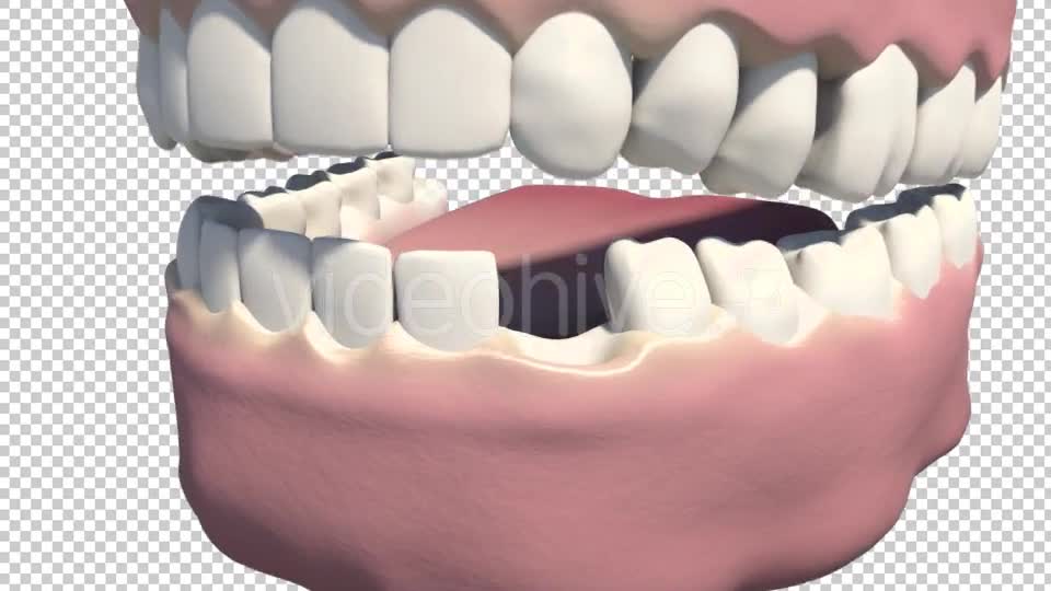 Dental Implants Videohive 19245111 Motion Graphics Image 1