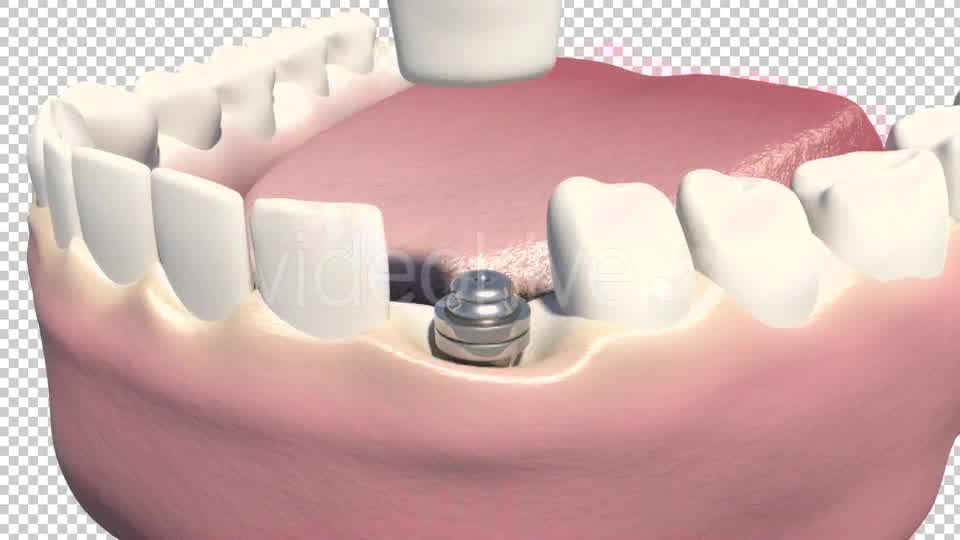 Dental Implants Videohive 19245111 Motion Graphics Image 10