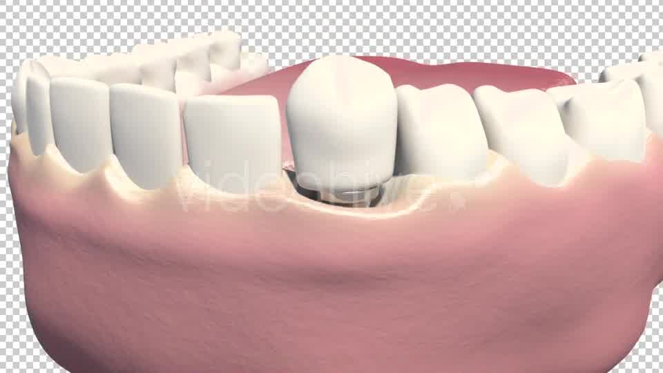 Dental Implants Videohive 19245111 Motion Graphics Image 11